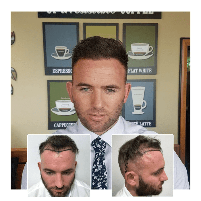 before after hair transplant harley street london 05