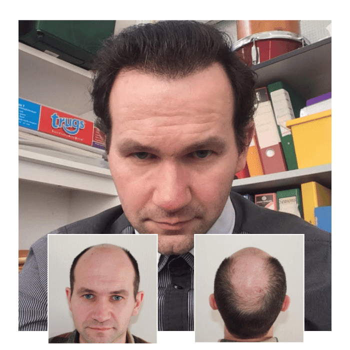 before after hair transplant harley street london 07